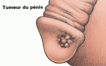 tumeur-penis